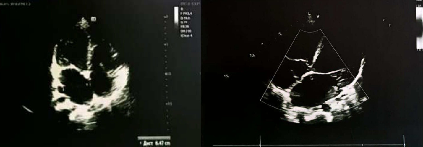 Эхокардиографическое исследование Пациентки на догоспитальном этапе: визуализация выраженной дилатации полостей сердца