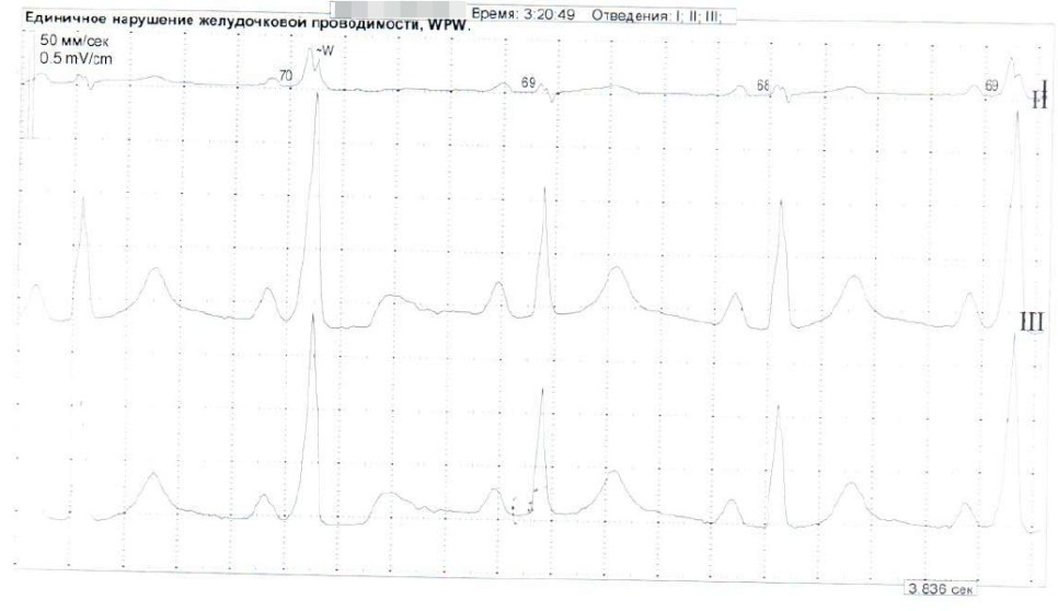 Фрагмент суточного мониторирования ЭКГ по Холтеру