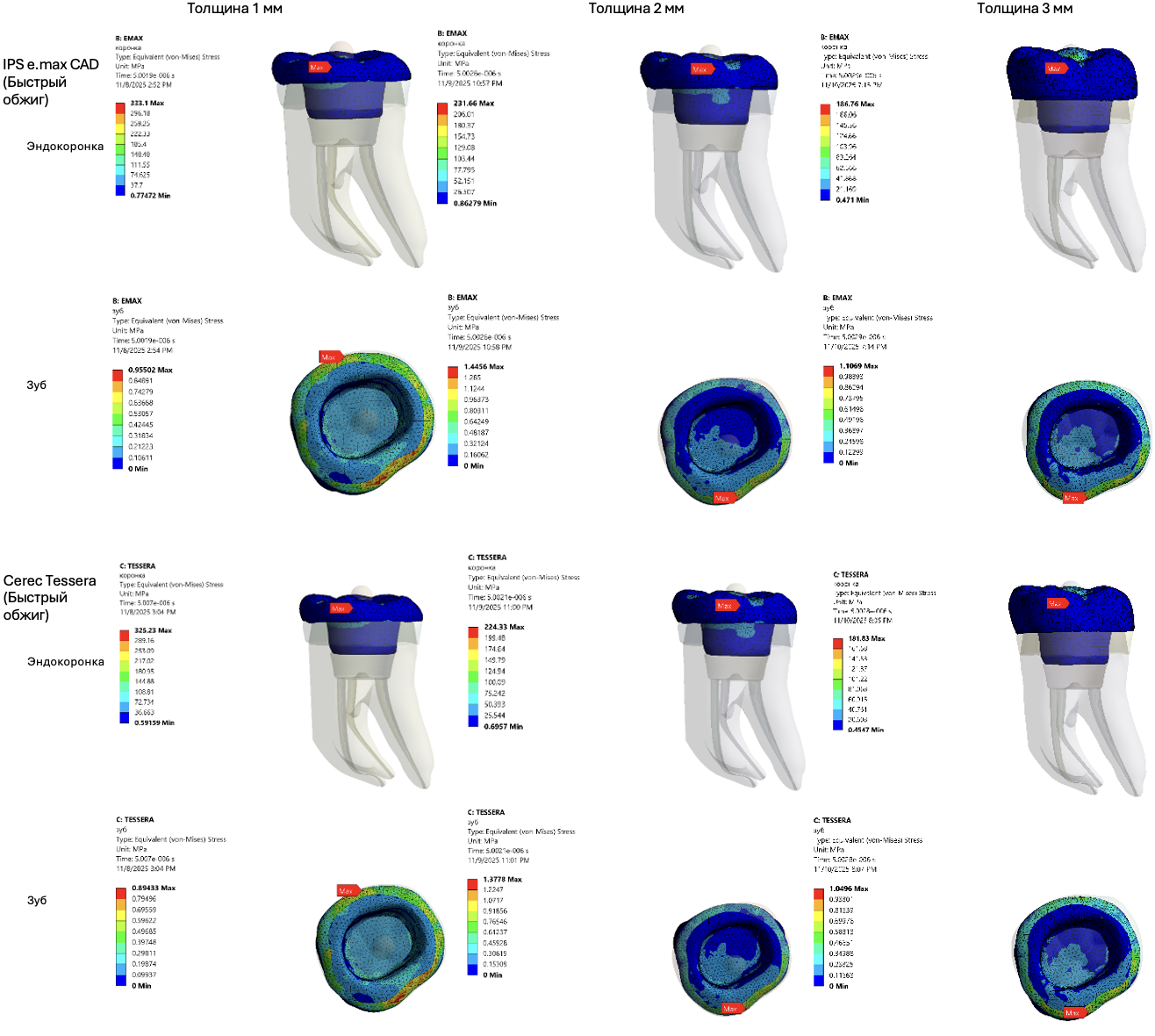 Распределение стресса фон Мизеса (МПa) на эндокоронки группы «Силикатная керамика» и ткани зуба в 3D-моделях при вертикальной нагрузке
