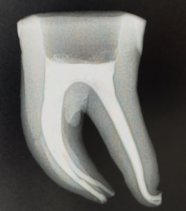 Прицельный рентгеновский снимок подготовленного удаленного моляра