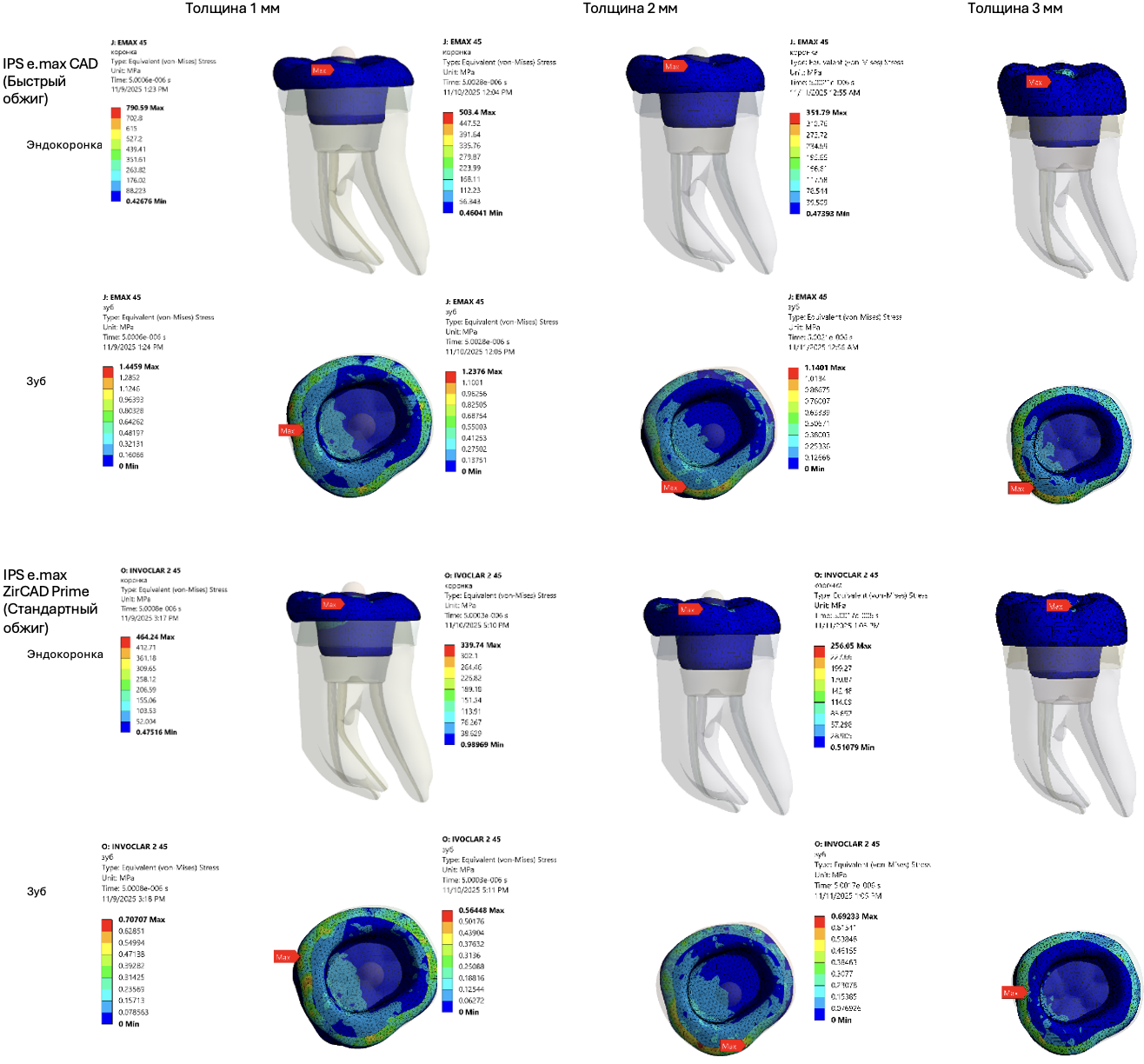 Распределение стресса фон Мизеса (МПa) на эндокоронки группы «Диоксид циркония» и «Силикатная керамика» и ткани зуба в 3D-моделях при нагрузке под углом углом 45º
