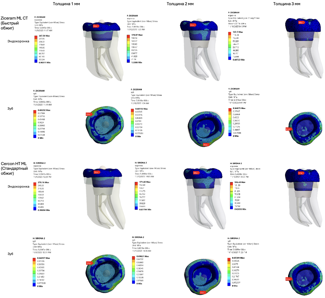 Распределение стресса фон Мизеса (МПa) на эндокоронки группы «Диоксид циркония» и ткани зуба в 3D-моделях при вертикальной нагрузке