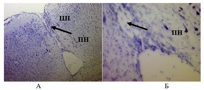 Ткань мозга крысы из опытной группы через 28 суток:А – Ув.´100; Б – Ув.´400