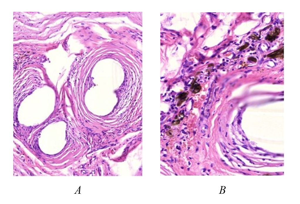 Structure of the connective tissue capsule around the polypropylene mesh: A – concentric low-cell-density layers of collagen fibers with a smooth transition into the surrounding connective tissue, absence of inflammatory changes and giant cell reaction to the implant; B – plate-like and needle-like coating particles in close proximity to the implant, surrounded by vascularized loose fibrous connective tissue with a moderate number of lymphohistiocytic elements