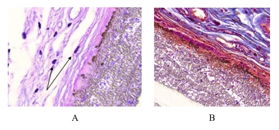 180 days after implantation of a polytetrafluoroethylene plate with a carbon coating: A – tight adhesion of the implant to the connective tissue, the carbon coating layer is preserved as a narrow brown stripe; intact mast cells are indicated by arrows; B – section of the implant surface showing layers of immature collagen fibers of the forming capsule and surrounding abdominal wall tissues with bundles of mature collagen fibers (blue color); connective tissue does not grow into the thickness of the implant; between the capsule fibers and the implant surface, there are few small foreign body cells