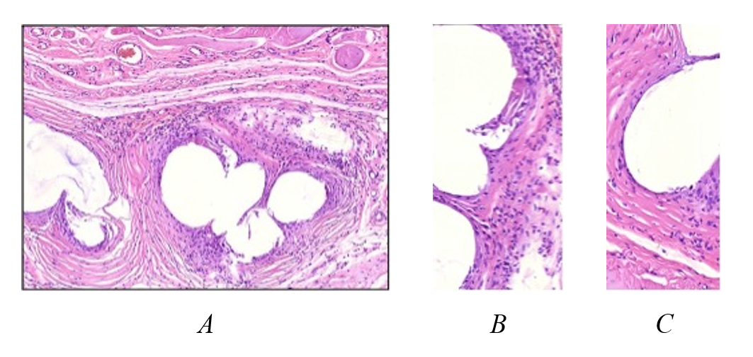 Structure of the capsule of an uncoated polypropylene implant after 6 months: the connective tissue is heterogeneous, with predominance of areas of dense fibrous structure (C) containing few fibrocyte-like cells; up to one-third of the area consists of regions with pronounced infiltration by polymorphonuclear leukocytes, predominantly eosinophils (B); foreign body cells are absent, but epithelioid histiocyte-like cells are present on the inner surface of the capsule