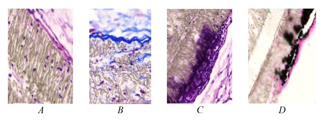 180 days after implantation of an uncoated polytetrafluoroethylene plate: A – the implant structure is moderately loosened; on the outside, single loosened collagen fibers of the connective tissue of the anterior abdominal wall1; B – leukocyte migration into the pores of the material, ingrowth of single thin collagen fibers2; C – giant foreign body cell layer3; D – area of calcification in the region of foreign body cell accumulation4