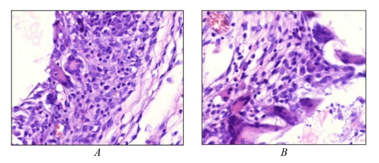 Implantation area of polypropylene hernioplasty meshes without coating: A – structure of granulation tissue around the uncoated polypropylene implant on day 14 of the experiment: mixed polymorphic cellular composition with a predominance of leukocytes and histiocytes, presence of multinucleated foreign body giant cells; B – numerous giant multinucleated foreign body cells around the implant on day 14 of the experiment