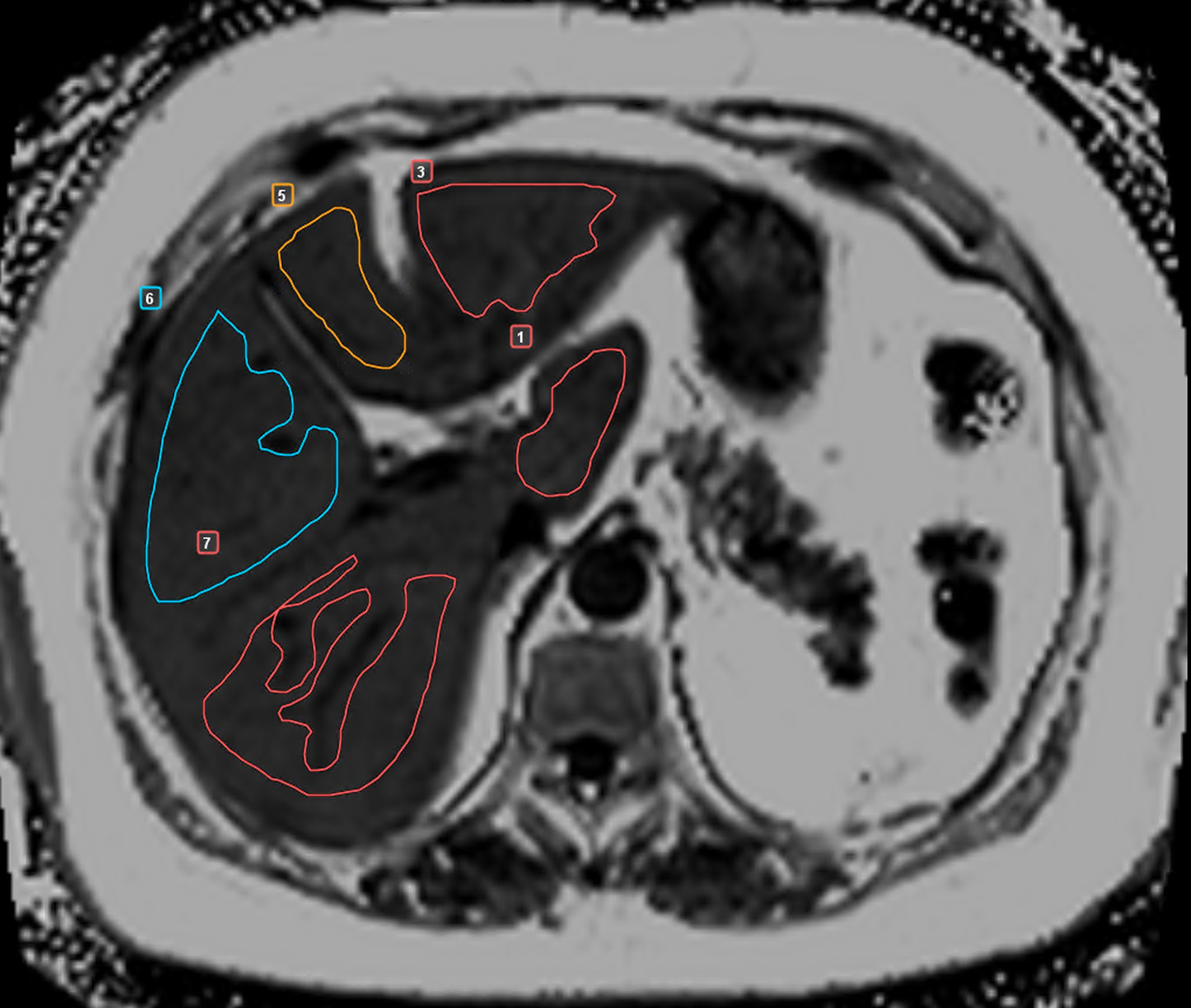 Пример измерений протонной плотности жировой фракции в S1, S3, S4b, S5 и S6 печени