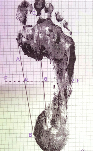 Схема расчета индекса стопы по методике И.М. Чижина