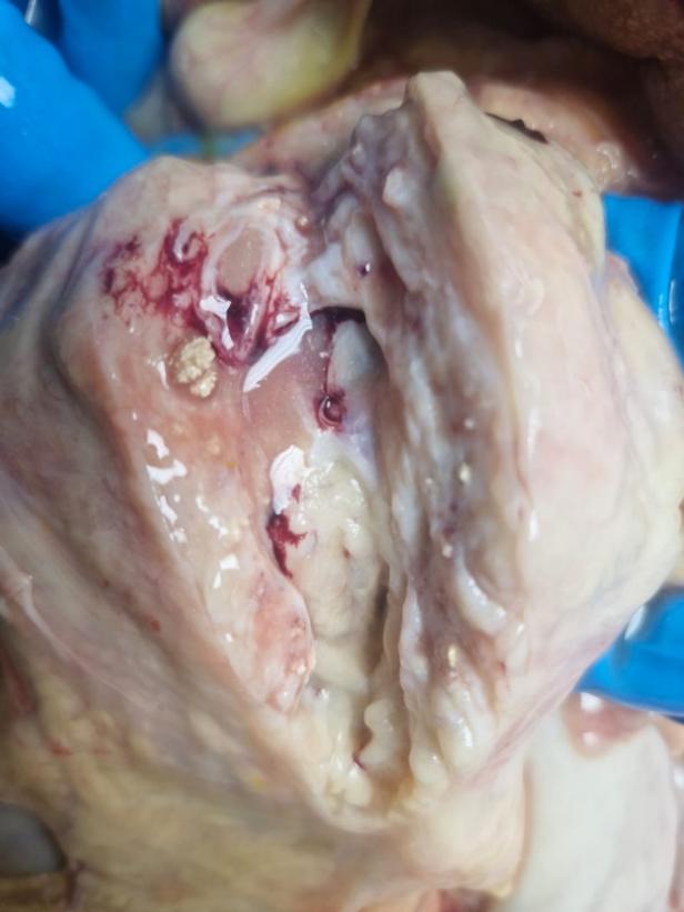 Пример аутопсийного материала, деструктивные изменения поджелудочной железы