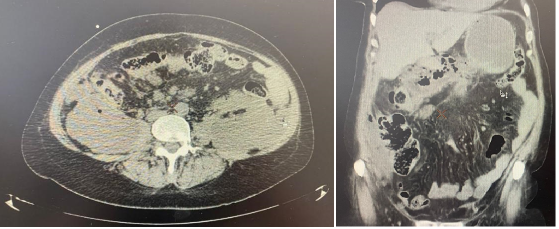 Пример компьютерной томографии течения острого панкреатита