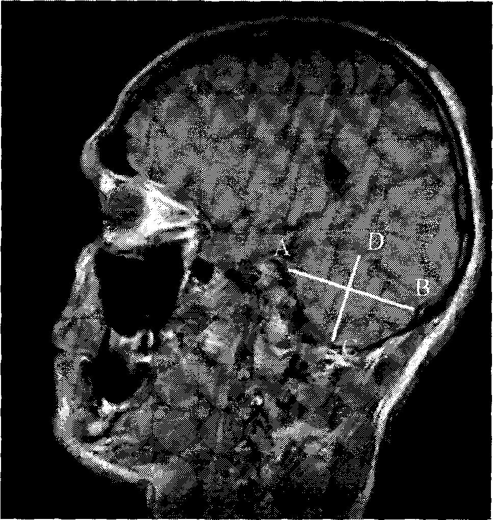 Т1-ВИ в сагиттальной плоскости (второй парасагиттальный срез): AB – длина полушария мозжечка; CD – высота полушария мозжечка