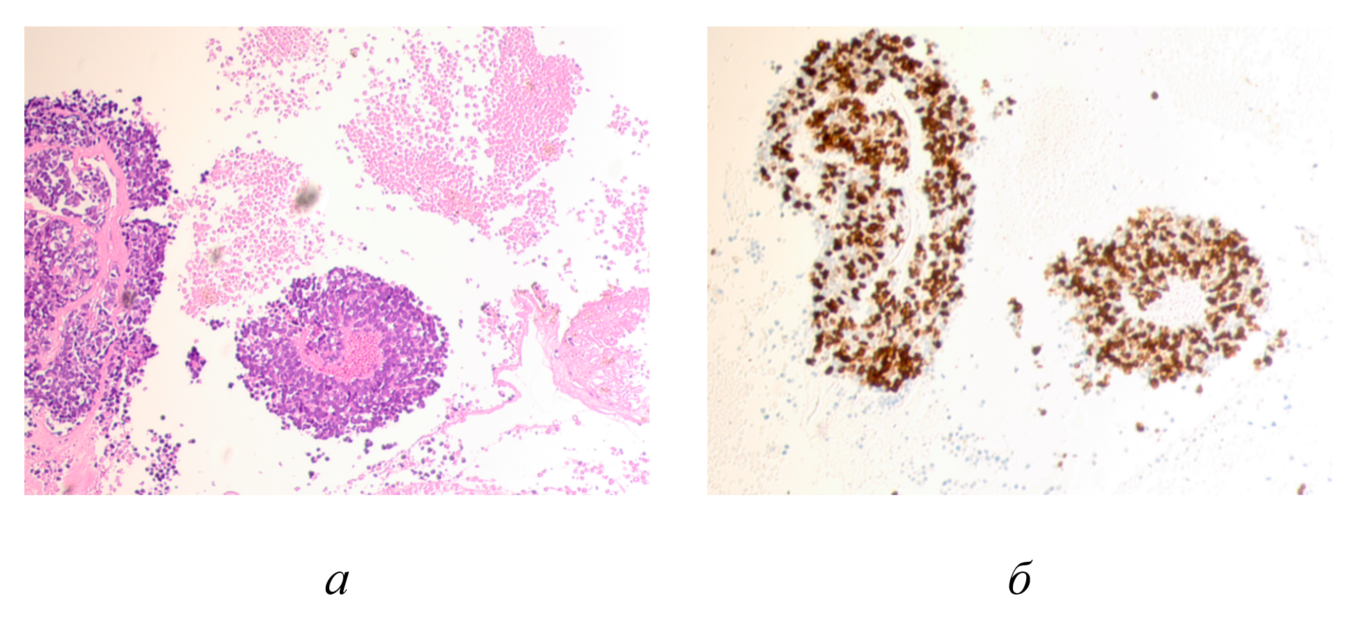 The eye of a 9-year-old boy with retinoblastoma: a - hematoxylin and eosin; b - immunohistochemistry to identify the location of Ki67-positive cells
