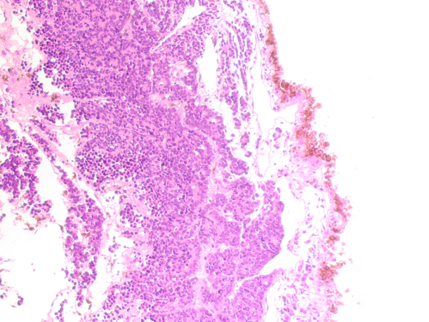 Eye of a 9-year-old boy