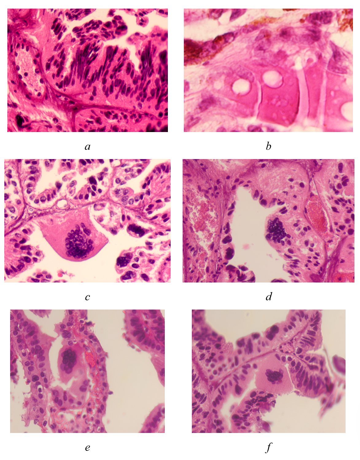 Melanoma of the choroid and ciliary body of the human eye: a - spindle-shaped cells; b - epithelioid cells with nuclei, devoid of chromatin with vesicular inclusions in the cytoplasm and foamy cytoplasm; c, d, e, f - multinucleated tumor cells