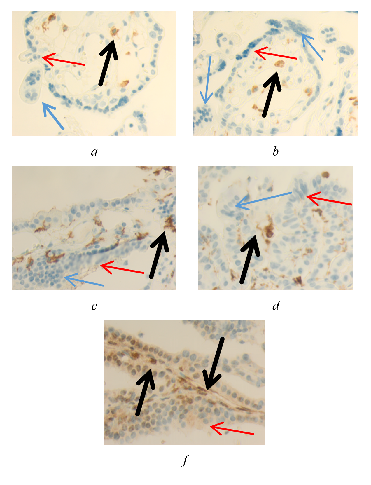 Uveal melanoma of the human eye: a, b - CD68 positive cell; c, d - CD163 positive cell; f - p53 positive cell