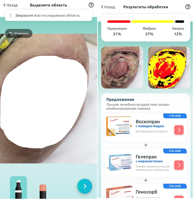 Скриншоты интерфейса приложения RAN.PRO. График демонстрирует стабилизацию площади раневого дефекта в течение предоперационного периода, послужившую объективным основанием для планирования некрэктомии