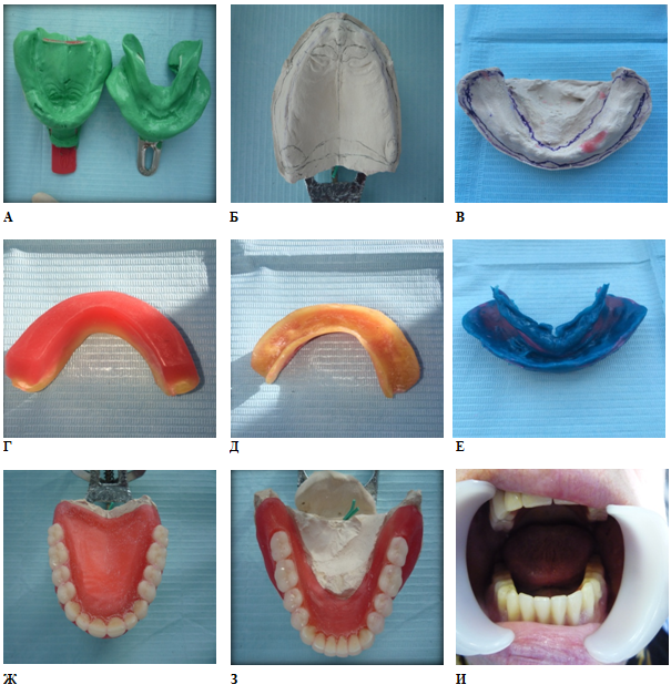 Этапы изготовления протеза. А23.07. 002.040 Полный съемный протез. Базис пластиночного протеза. Иммедиат-протез полный съемный пластиночный протез. Пластиночный протез с двухслойным базисом.