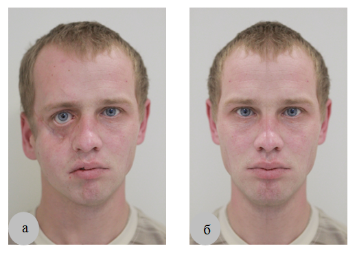 Изменения с 6 апреля. Посттравматические деформации лица. Исправление асимметрии лица. Челюстно лицевая хирургия асимметрия лица. Асимметрия костей лица.